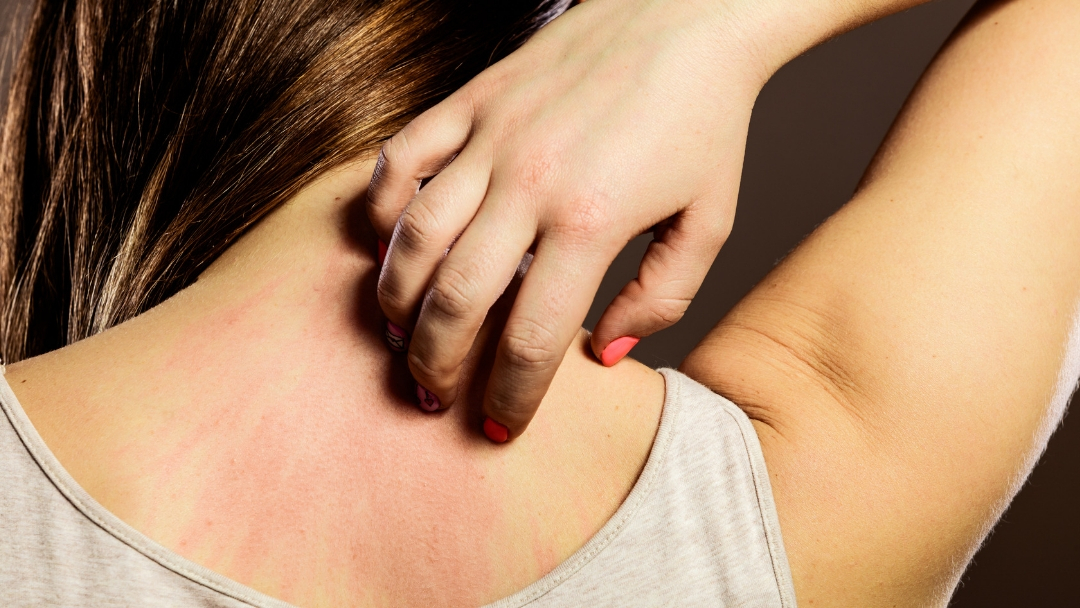 8 Evidence-Based, Holistic Approaches to Eczema